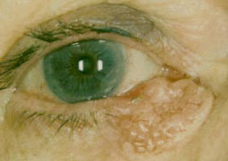 , Facial/Eyelid Skin Cancer