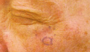 , Facial/Eyelid Skin Cancer