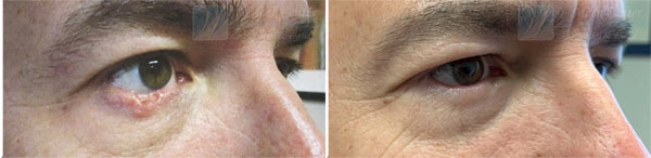 Real Patient before and after facial plastic surgery results in Tampa, FL, performed by Dr. Mack.
