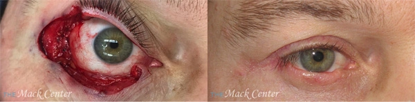 Real Patient before and after facial plastic surgery results in Tampa, FL, performed by Dr. Mack.