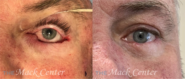 Real Patient before and after facial plastic surgery results in Tampa, FL, performed by Dr. Mack.