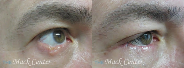 Real Patient before and after facial plastic surgery results in Tampa, FL, performed by Dr. Mack.