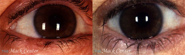 Real Patient before and after facial plastic surgery results in Tampa, FL, performed by Dr. Mack.