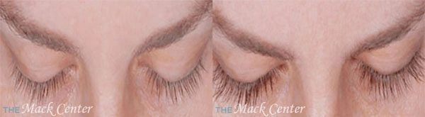 Real Patient before and after facial plastic surgery results in Tampa, FL, performed by Dr. Mack.