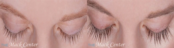 Real Patient before and after facial plastic surgery results in Tampa, FL, performed by Dr. Mack.