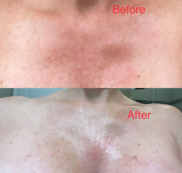 Real Patient before and after facial plastic surgery results in Tampa, FL, performed by Dr. Mack.