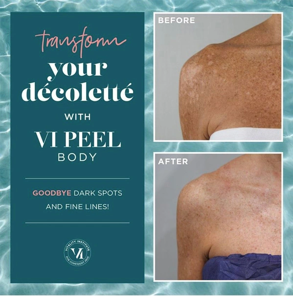 Real Patient before and after facial plastic surgery results in Tampa, FL, performed by Dr. Mack.