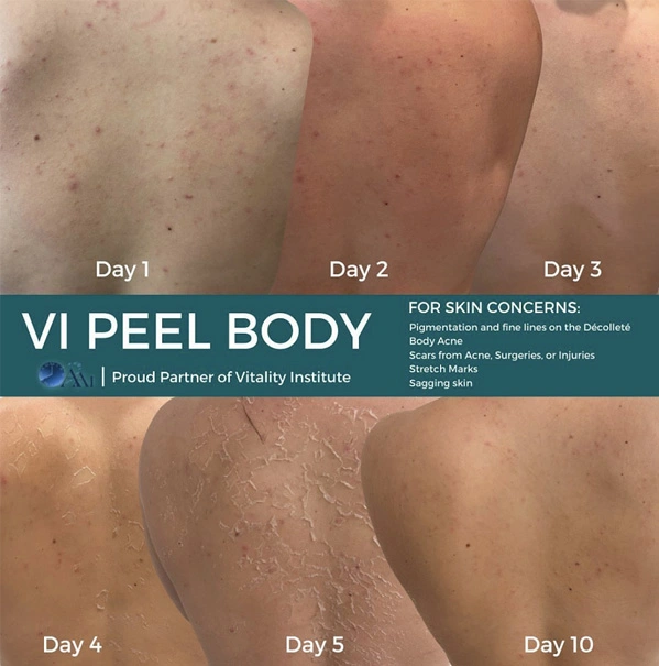 Real Patient before and after facial plastic surgery results in Tampa, FL, performed by Dr. Mack.