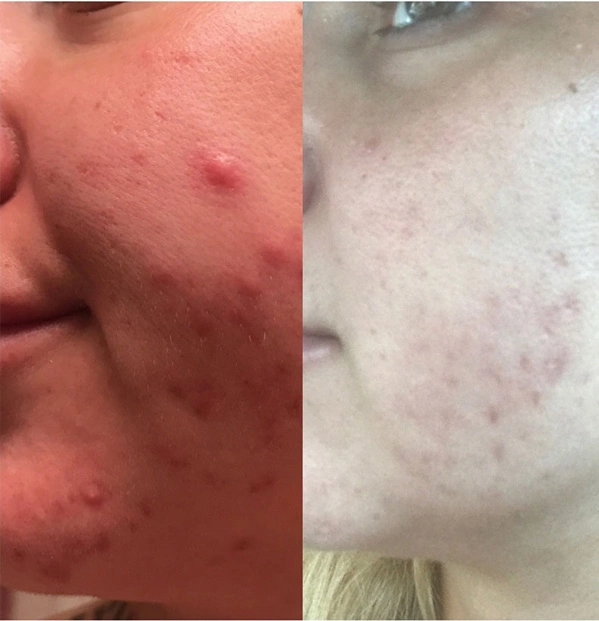 Real Patient before and after facial plastic surgery results in Tampa, FL, performed by Dr. Mack.