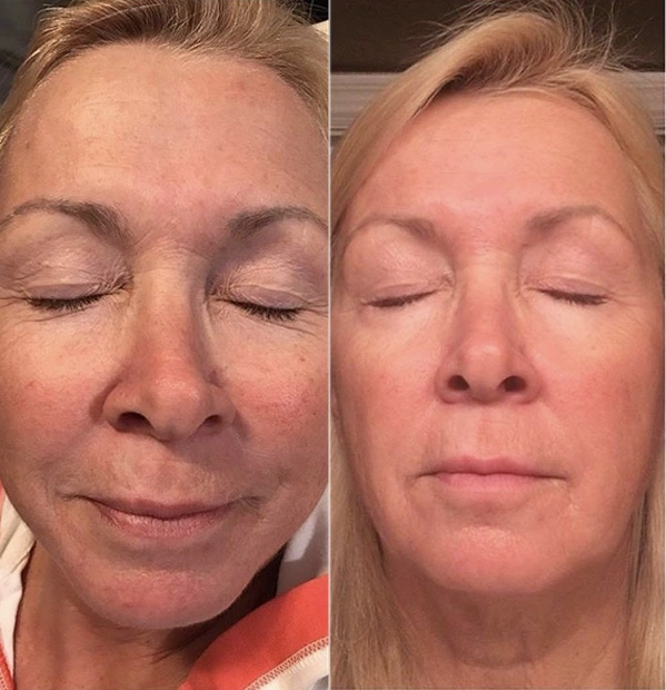 Real Patient before and after facial plastic surgery results in Tampa, FL, performed by Dr. Mack.