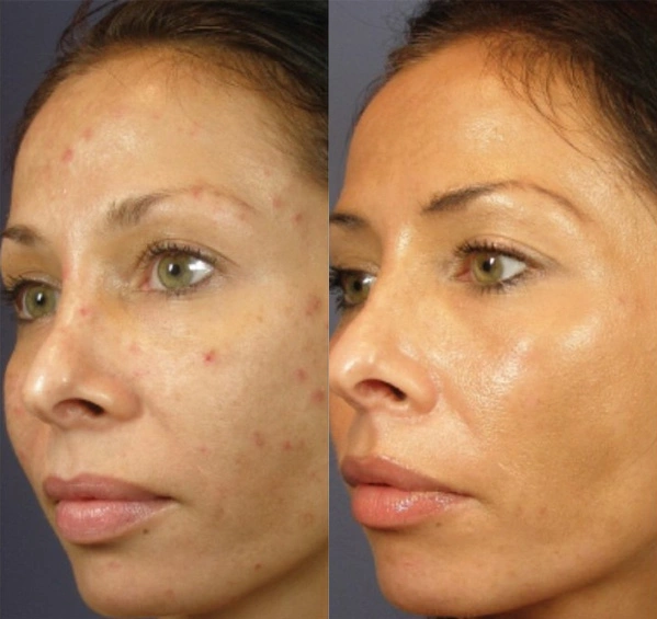 Real Patient before and after facial plastic surgery results in Tampa, FL, performed by Dr. Mack.