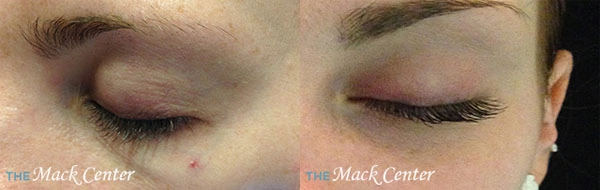 Real Patient before and after facial plastic surgery results in Tampa, FL, performed by Dr. Mack.
