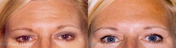 Real Patient before and after facial plastic surgery results in Tampa, FL, performed by Dr. Mack.