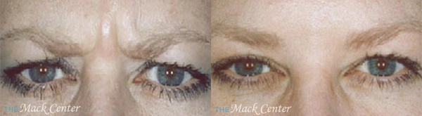 Real Patient before and after facial plastic surgery results in Tampa, FL, performed by Dr. Mack.
