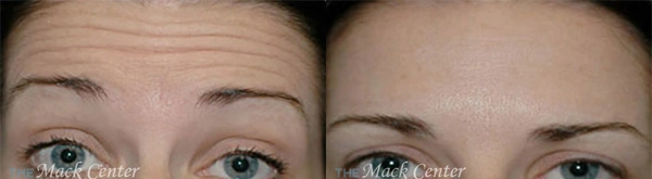 Real Patient before and after facial plastic surgery results in Tampa, FL, performed by Dr. Mack.