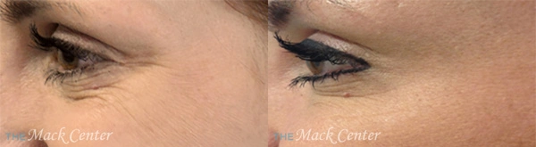 Real Patient before and after facial plastic surgery results in Tampa, FL, performed by Dr. Mack.