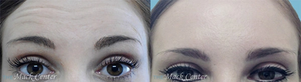 Real Patient before and after facial plastic surgery results in Tampa, FL, performed by Dr. Mack.