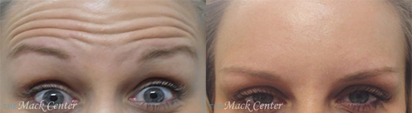 Real Patient before and after facial plastic surgery results in Tampa, FL, performed by Dr. Mack.