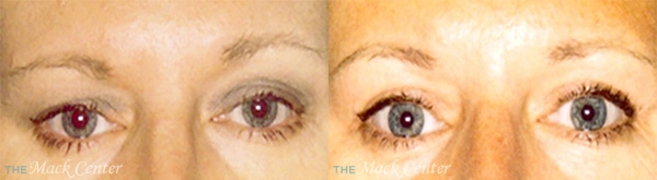 Real Patient before and after facial plastic surgery results in Tampa, FL, performed by Dr. Mack.