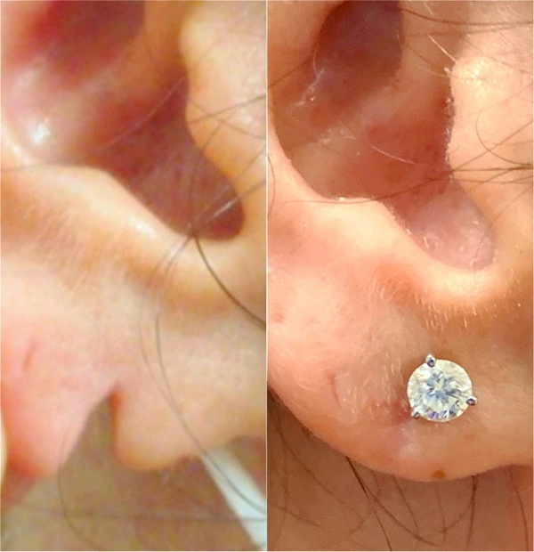 Real Patient before and after facial plastic surgery results in Tampa, FL, performed by Dr. Mack.