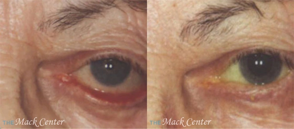 Real Patient before and after facial plastic surgery results in Tampa, FL, performed by Dr. Mack.