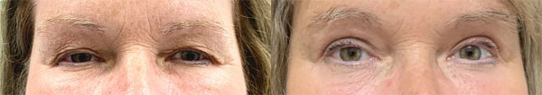 Real Patient before and after facial plastic surgery results in Tampa, FL, performed by Dr. Mack.
