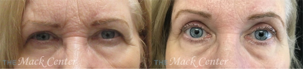 Real Patient before and after facial plastic surgery results in Tampa, FL, performed by Dr. Mack.