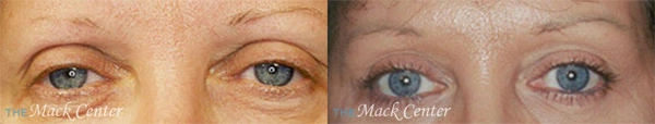 Real Patient before and after facial plastic surgery results in Tampa, FL, performed by Dr. Mack.