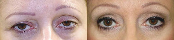Real Patient before and after facial plastic surgery results in Tampa, FL, performed by Dr. Mack.