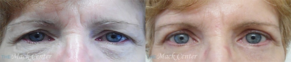 Real Patient before and after facial plastic surgery results in Tampa, FL, performed by Dr. Mack.