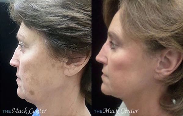 Real Patient before and after facial plastic surgery results in Tampa, FL, performed by Dr. Mack.