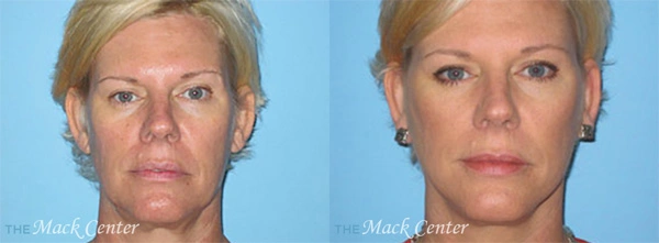 Real Patient before and after facial plastic surgery results in Tampa, FL, performed by Dr. Mack.