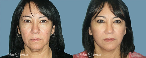Real Patient before and after facial plastic surgery results in Tampa, FL, performed by Dr. Mack.