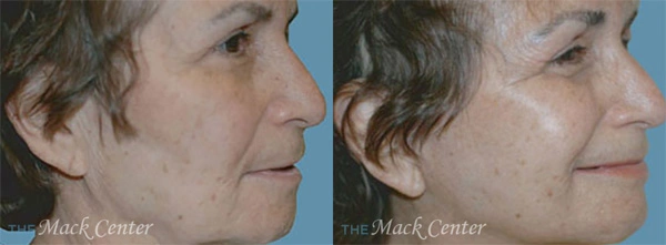 Real Patient before and after facial plastic surgery results in Tampa, FL, performed by Dr. Mack.