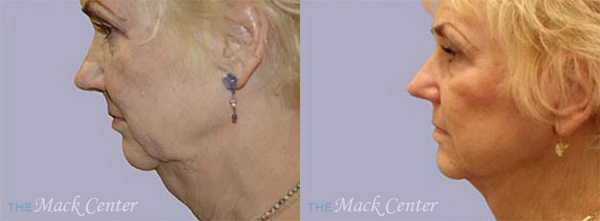 Real Patient before and after facial plastic surgery results in Tampa, FL, performed by Dr. Mack.