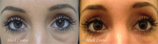 Real Patient before and after facial plastic surgery results in Tampa, FL, performed by Dr. Mack.