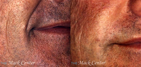 Real Patient before and after facial plastic surgery results in Tampa, FL, performed by Dr. Mack.