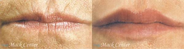 Real Patient before and after facial plastic surgery results in Tampa, FL, performed by Dr. Mack.