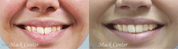 Real Patient before and after facial plastic surgery results in Tampa, FL, performed by Dr. Mack.