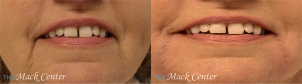 Real Patient before and after facial plastic surgery results in Tampa, FL, performed by Dr. Mack.