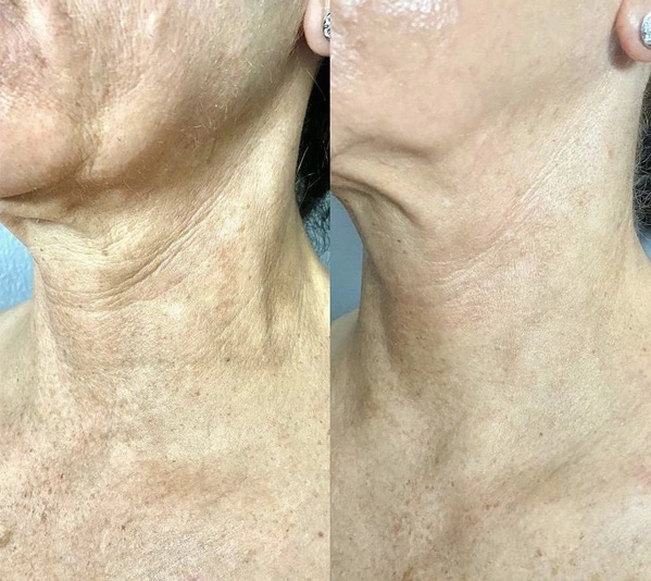 Real Patient before and after facial plastic surgery results in Tampa, FL, performed by Dr. Mack.