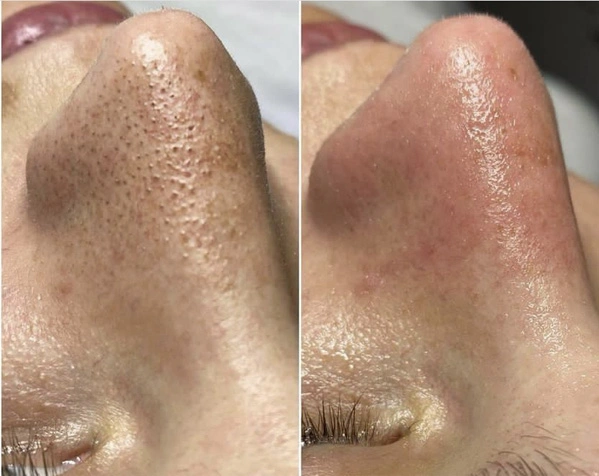 Real Patient before and after facial plastic surgery results in Tampa, FL, performed by Dr. Mack.