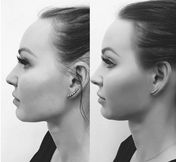 Real Patient before and after facial plastic surgery results in Tampa, FL, performed by Dr. Mack.