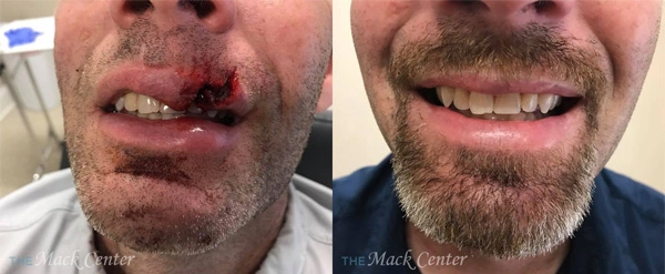 Real Patient before and after facial plastic surgery results in Tampa, FL, performed by Dr. Mack.