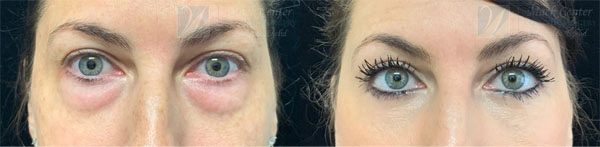 Real Patient before and after facial plastic surgery results in Tampa, FL, performed by Dr. Mack.