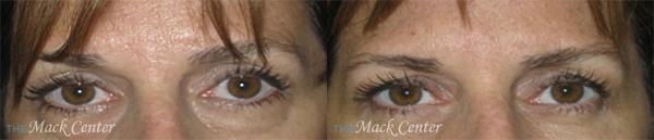 Real Patient before and after facial plastic surgery results in Tampa, FL, performed by Dr. Mack.