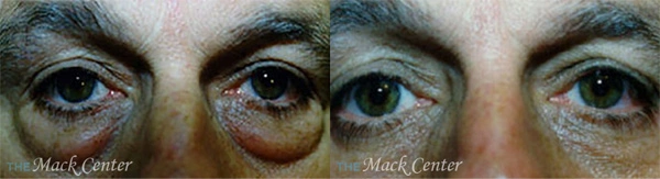Real Patient before and after facial plastic surgery results in Tampa, FL, performed by Dr. Mack.