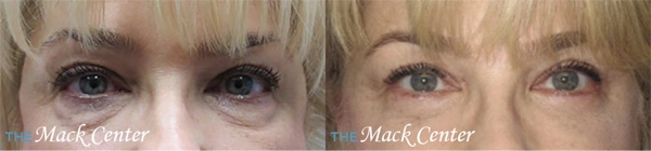 Real Patient before and after facial plastic surgery results in Tampa, FL, performed by Dr. Mack.