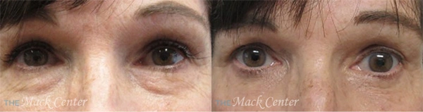 Real Patient before and after facial plastic surgery results in Tampa, FL, performed by Dr. Mack.