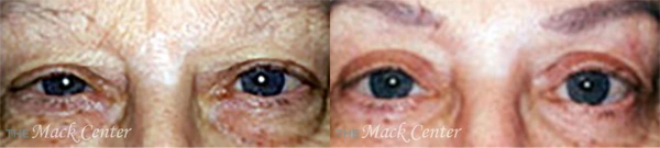 Real Patient before and after facial plastic surgery results in Tampa, FL, performed by Dr. Mack.